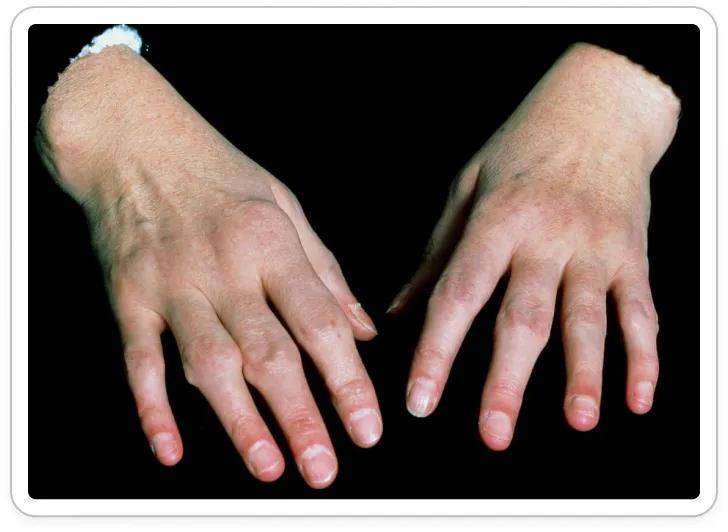 图5 类风湿关节炎手部畸形依次为:关节梭形肿胀,手指尺侧偏曲,纽扣花