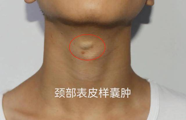 大多数囊肿无需处理?医生提醒:3个地方的囊肿,需提高警惕