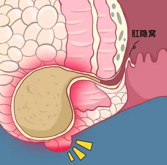 肛瘘卡通图片