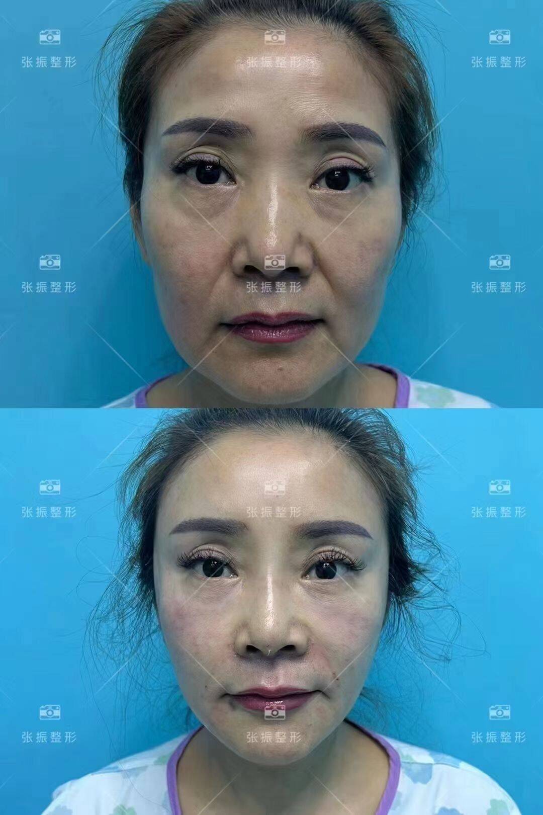 北京线雕提升口碑最好的医生有谁