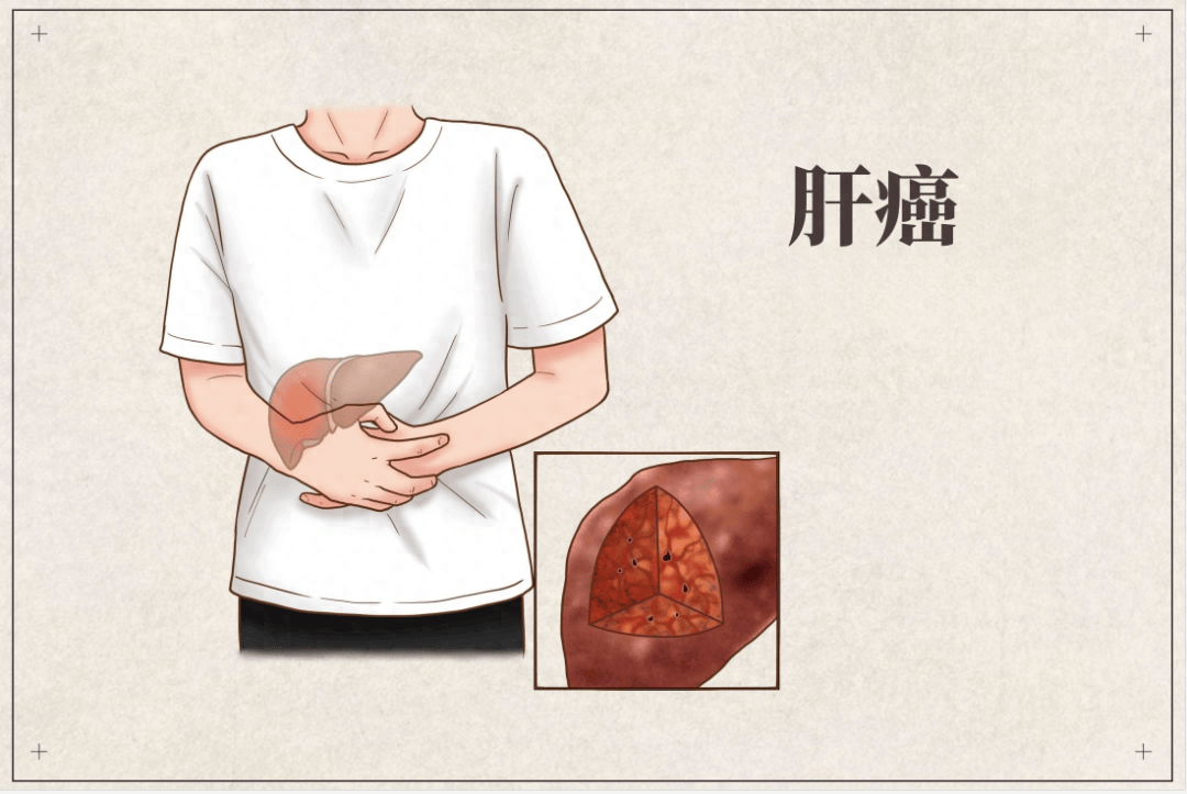 肝癌究竟是何方神圣?医生提醒 做好肝癌的三级预防