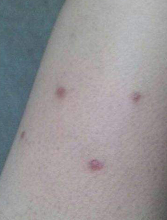 腿上有鸡皮肤怎么去除?一篇文章教你巧治鸡皮肤