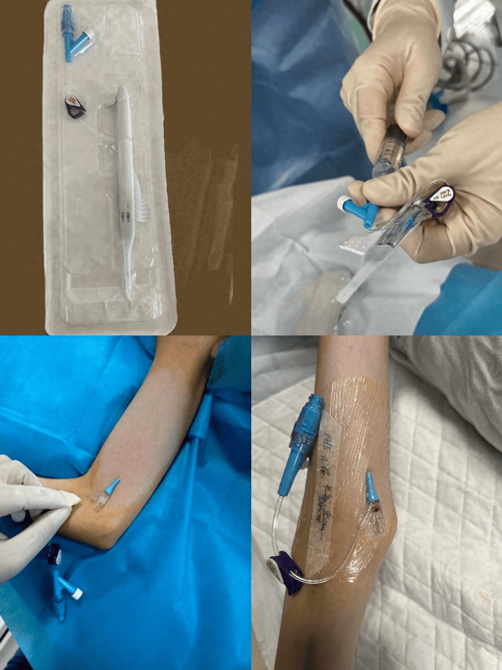 徐州市儿童医院创新开展儿童中等长度导管穿刺成功