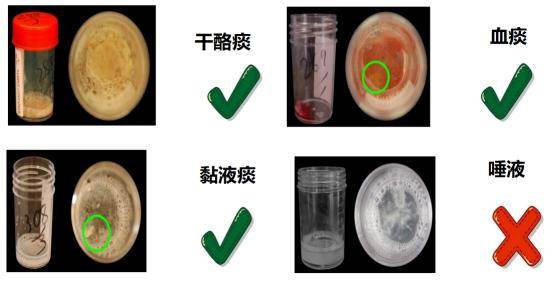 怎样留取结核分枝杆菌病原学检测的痰标本