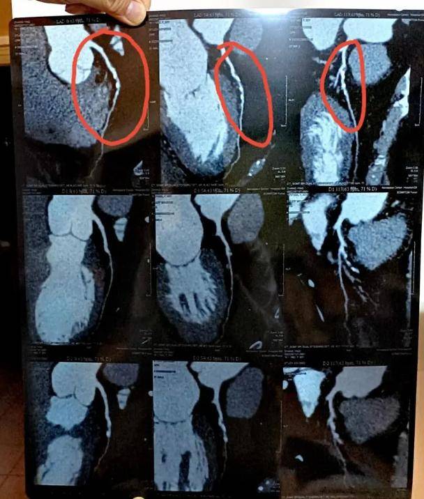 冠脉ct出现70%以下狭窄,为何医生还要做造影?这是过度医疗吗?