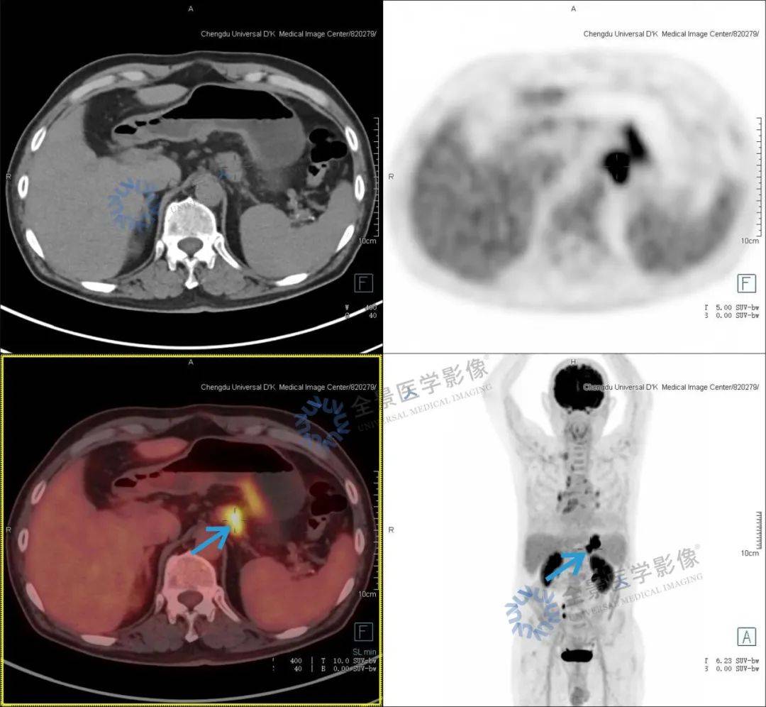 【胃癌案例】近期出现呕吐,腹泻症状,检查发现胃癌晚期