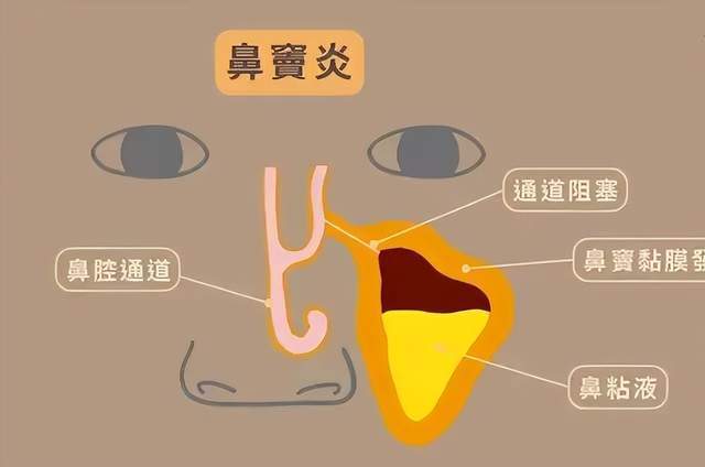 其主要症状包括:1,鼻塞:这是鼻窦炎的常见症状,患者会感到呼吸不畅.