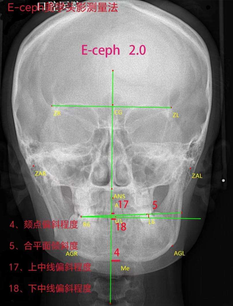 hzm美学头影测量法解析