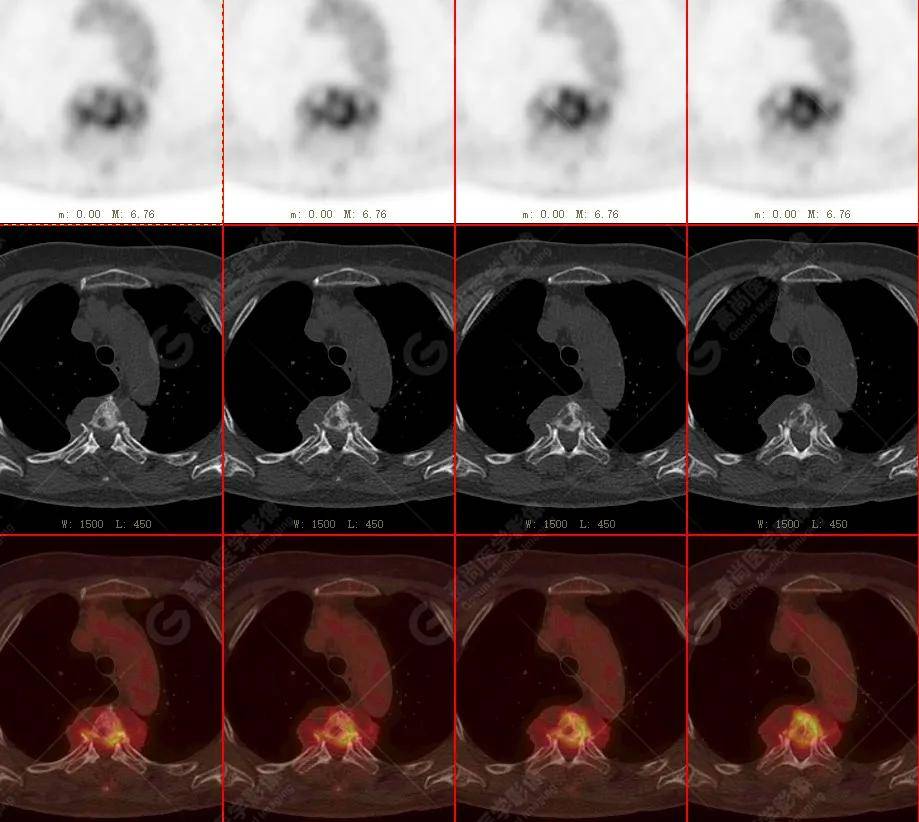 【高尚病例】18f-fdg pet/ct显像应用于骨结核