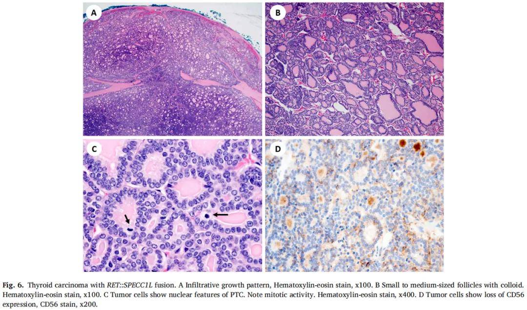 滤泡起源的甲状腺癌ngs检出率超高!