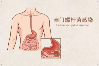 广州建康医院是正规的 幽门螺杆菌感染