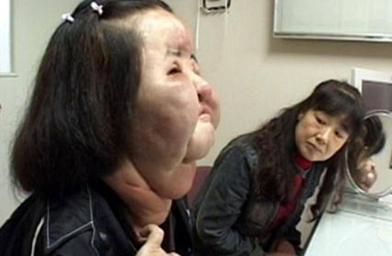 韩国女明星整容上瘾,自己向脸部注射食用油,9年无法闭眼睡觉
