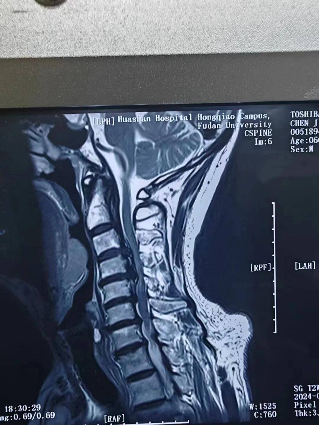 由于平时生活习惯的问题,66岁的老张长期受到颈椎问题的困扰.