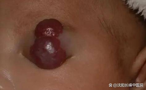 唇部血管瘤5mm图片