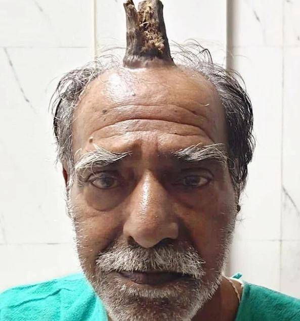 印度75岁男子头顶长出10厘米魔鬼之角,真实版小龙人