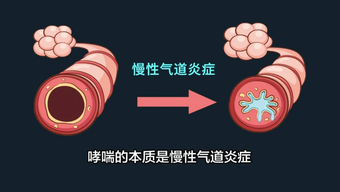 孟鲁司特钠颗粒多久一个疗程?