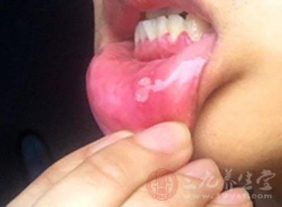 疱疹啥症状常做这件事竟会引起疱疹