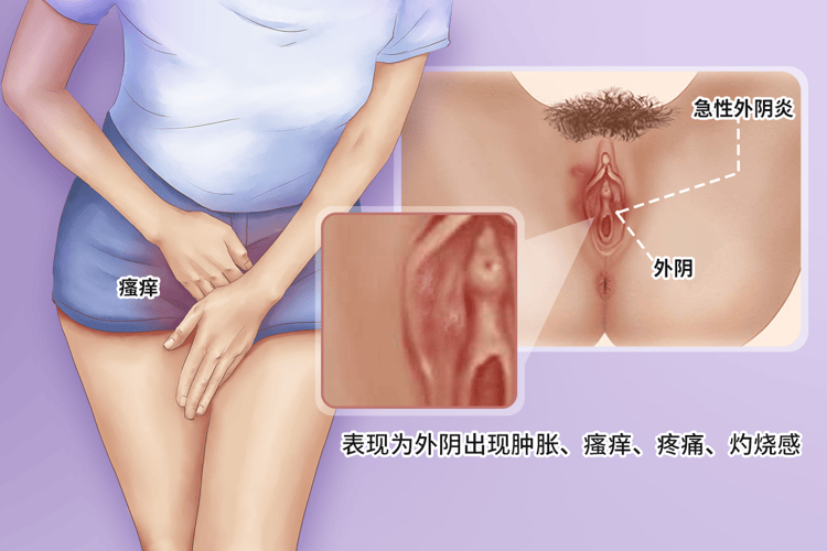 外阴癌的诱发因素、症状有哪些(如何预防外阴癌)