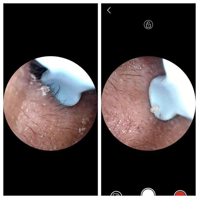 西圣Find智能可视耳勺:科技革新,让掏耳更智能更安全