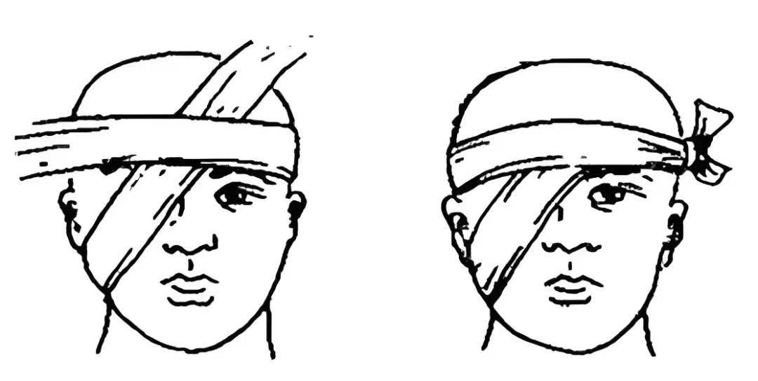 三角巾头部包扎法图片