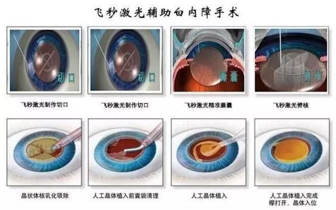 杭州临平太学眼科医院老花白内障手术用年轻视力,助老年人追求精彩