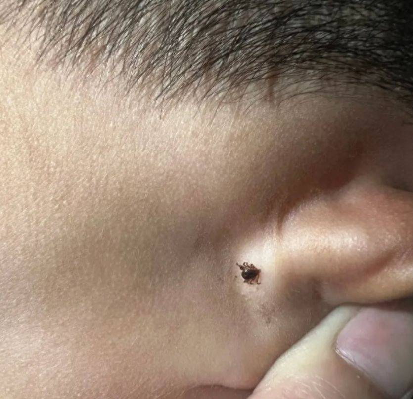 孩子被蜱虫咬,霸气爸爸的"三个果断"救了娃,医生:不用治了