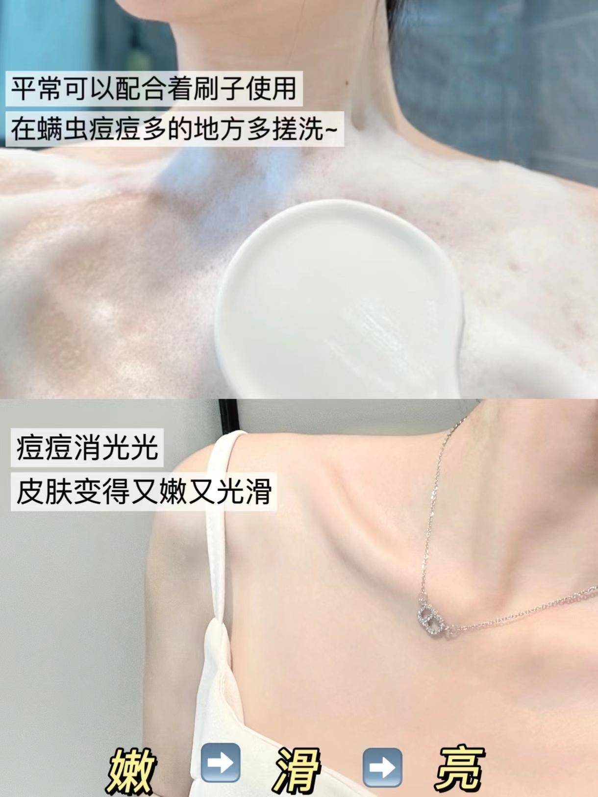 怎么能让痘痘不再发作?