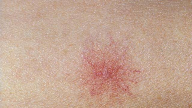 蜘蛛痣一般产生在上肢,面部,胸口,后背等地方,这类皮肤表现出来的红痣