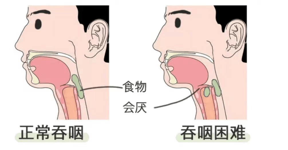 吞咽过程图图片