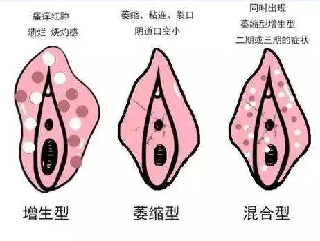 外阴白斑病照片 女性图片