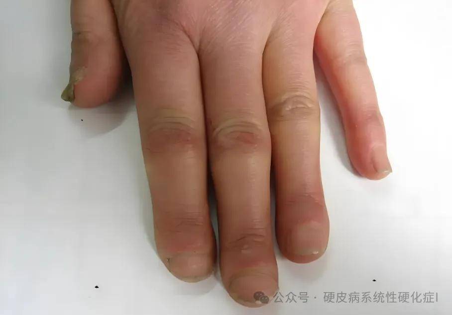 患上硬皮病还能活多久?