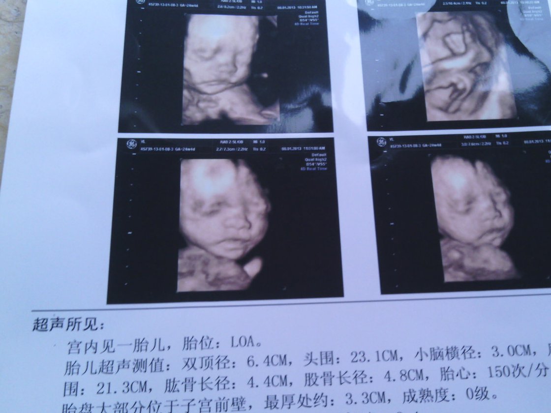 3,胎儿头部的轮廓四维彩超有一个特别好的优点就是能够清晰的看到宝宝