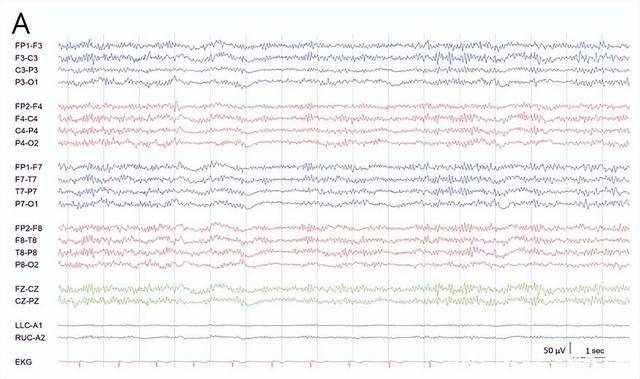 脑电图报告单图片