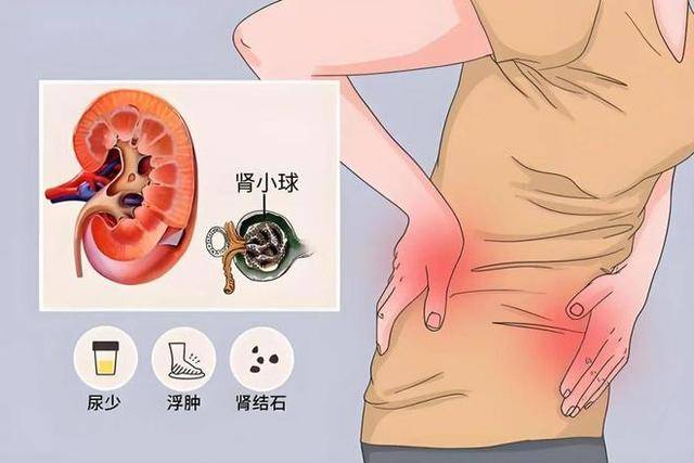 "肾透支"的5个信号,你有吗?若占3条以上,提示你或该节制了