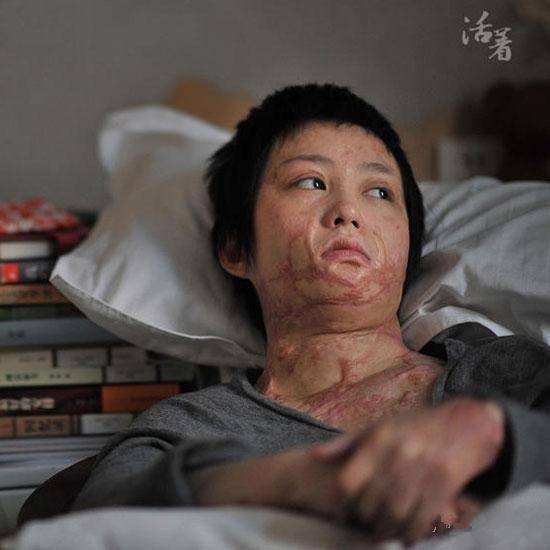 抢救脱离了生命危险,但一只耳朵被烧掉,头面部,颈部,胸部等严重烧伤