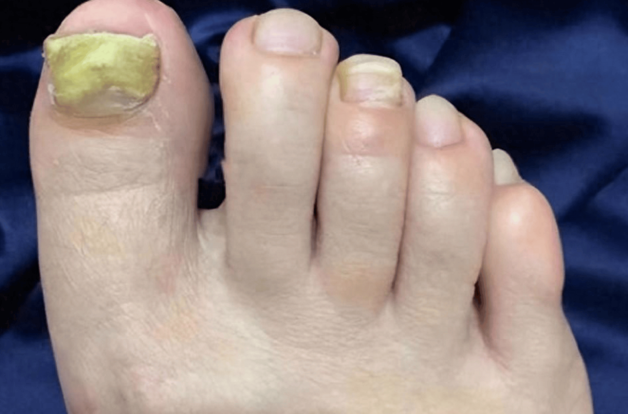 你的灰趾甲是怎么治好的?