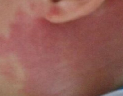 3,头部混合型血管瘤是毛细血管瘤和海绵状血管瘤同时存在的情况,症状