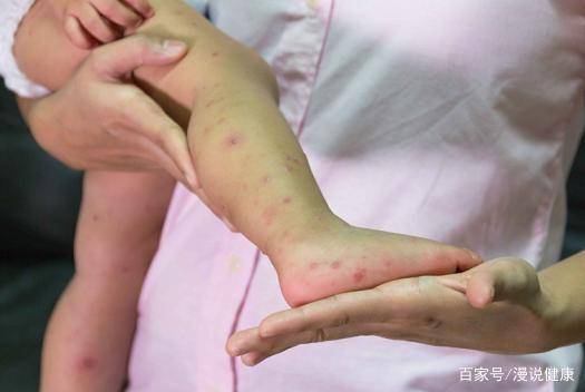 冬季宝宝湿疹大爆发的6大原因,宝妈们需要了解预防!