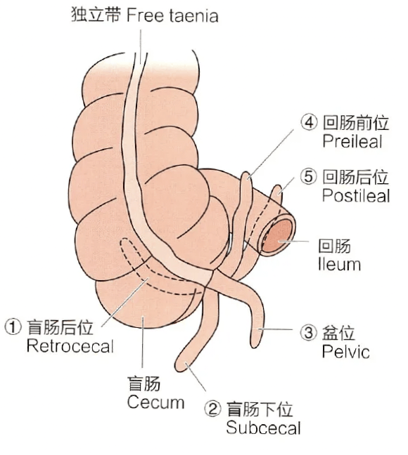 阑尾常见6种位置图片图片