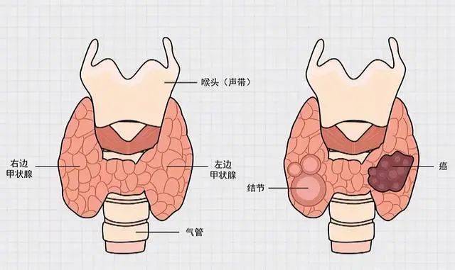 甲状旁腺解剖位置图片图片