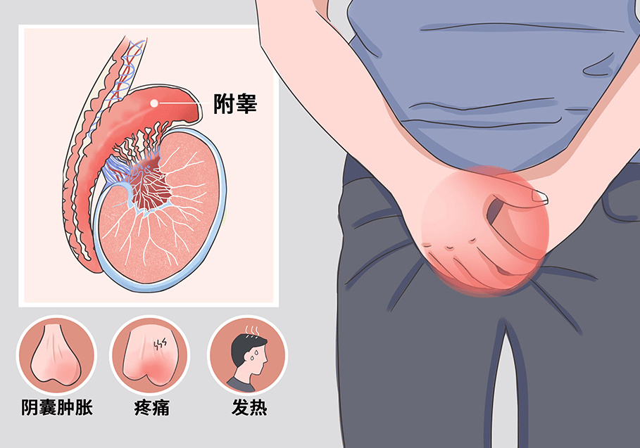 兴义阳光男科医生说 附睾炎不治