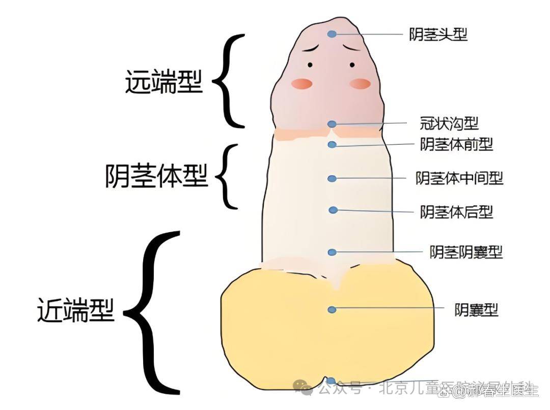 女性尿道下裂症状图片图片