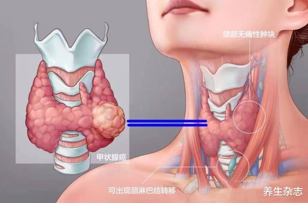 甲状旁腺的位置图片图片