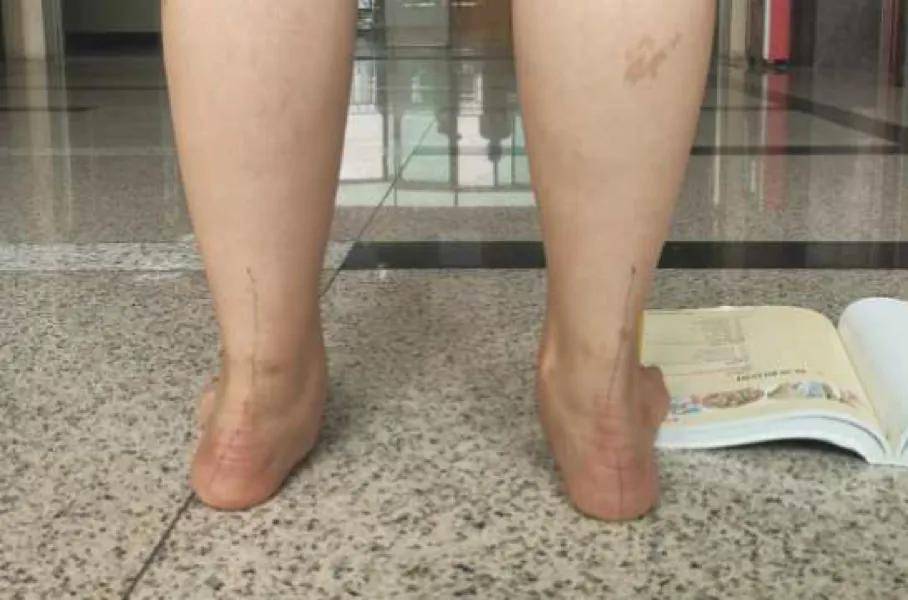 关注青少年扁平足,共筑健康成长路