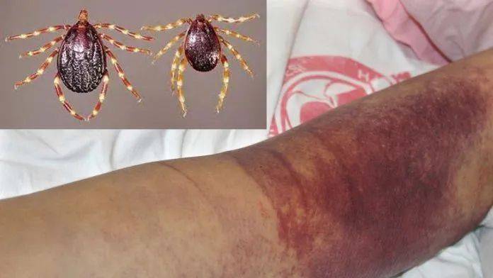 欧洲首例死亡!男子被巨型蜱虫叮咬后死亡