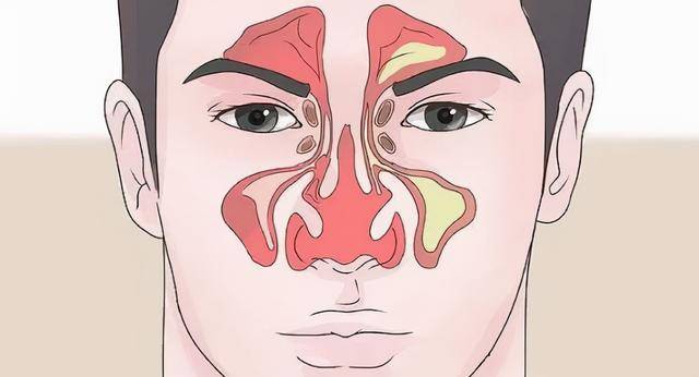 专家分享:蝶窦炎发作,受伤的不仅仅是鼻子!