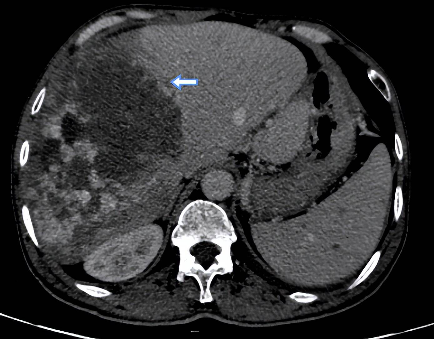肝血管瘤定期复查不容忽视!