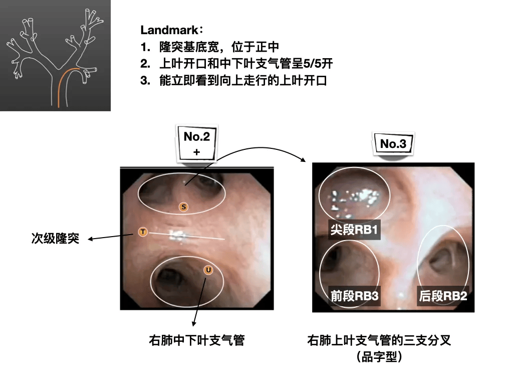 临床必备|纤维支气管镜入门图谱,一文分享!超实用!