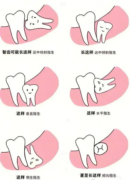 远中阻生图片