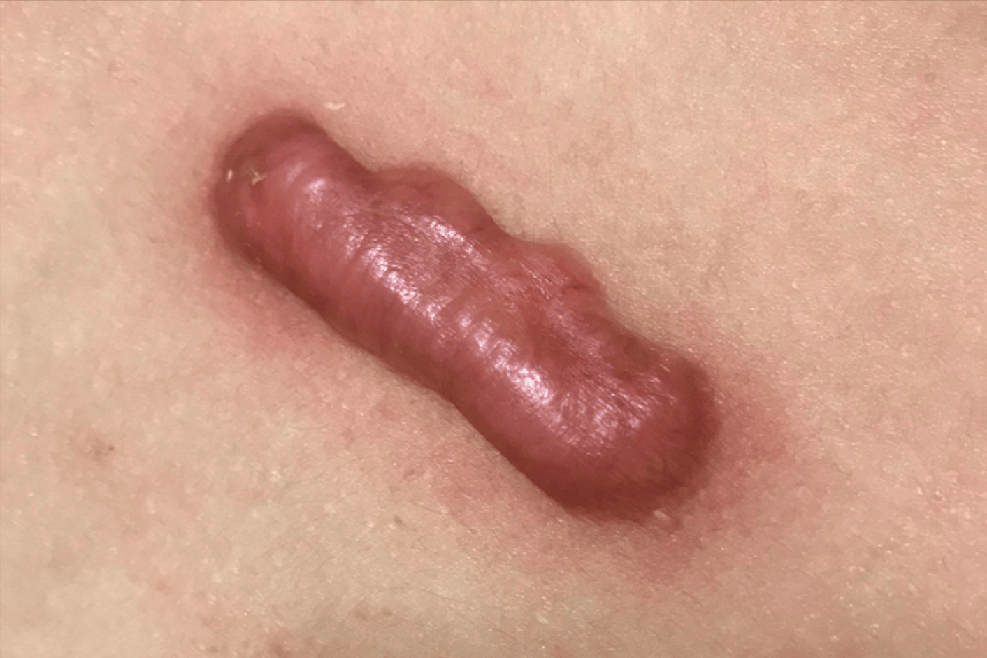 难缠的疤痕增生不用激光!跟着过来人这样做,秒没!